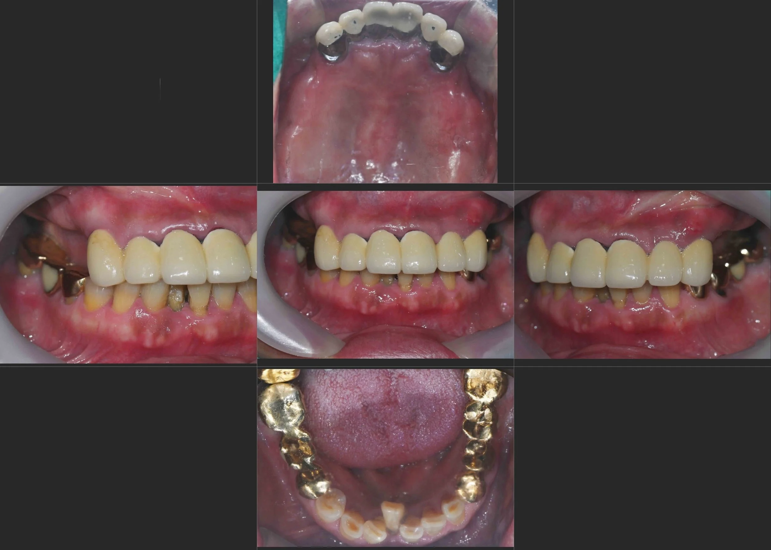 15. Bilateral Full Mouth Rehabilitation: Transitioning from Failing Dentures to Stable Fixed Prosthetics