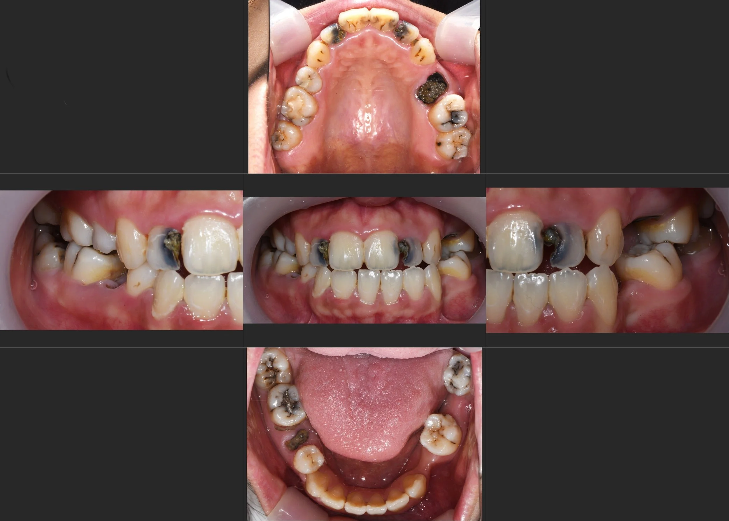 16. Overcoming Dental Phobia: Comprehensive Smile Transformation for Rampant Caries