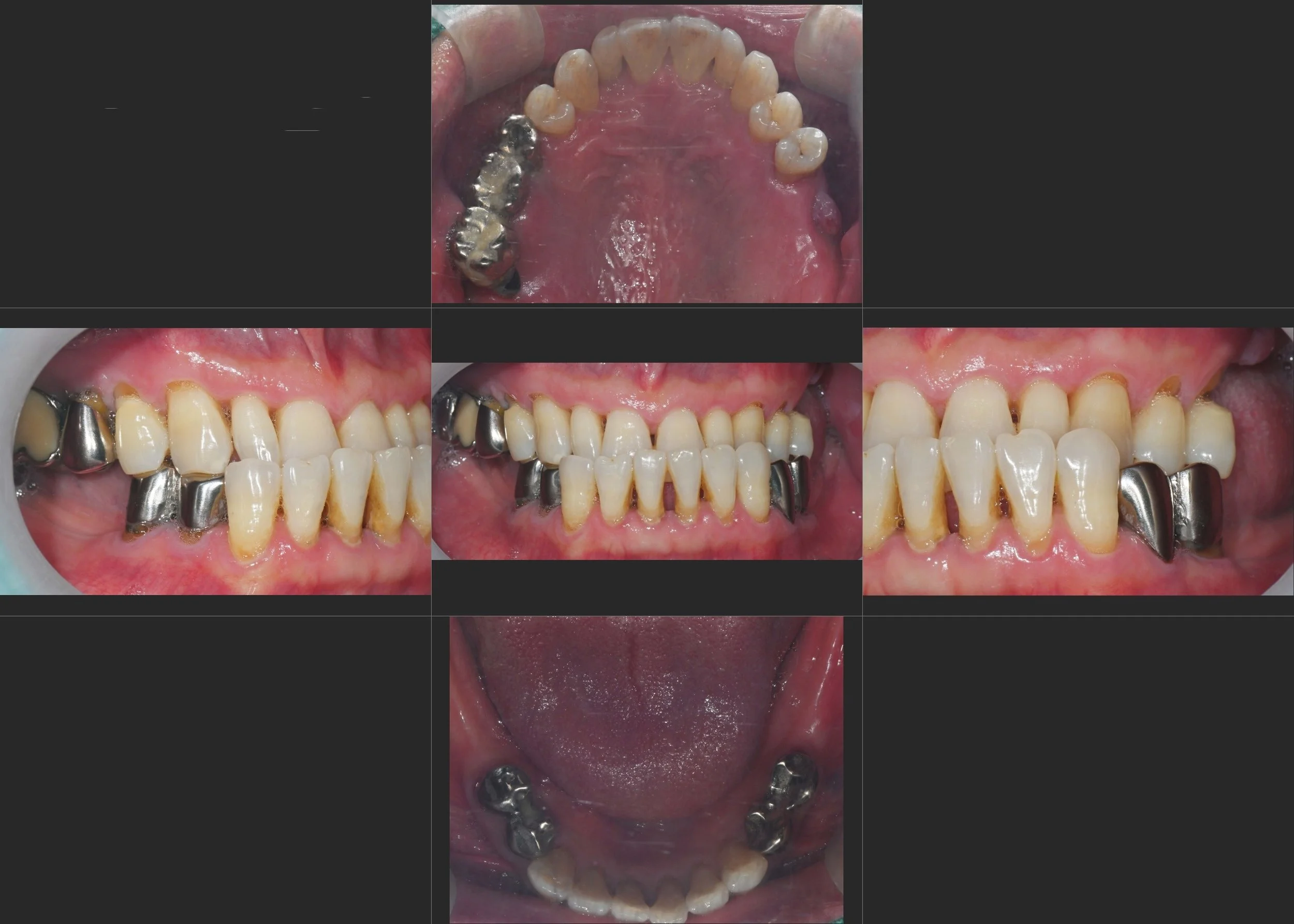 17. Reconstructing Class III Malocclusion: A Strategic Approach to VDO Elevation