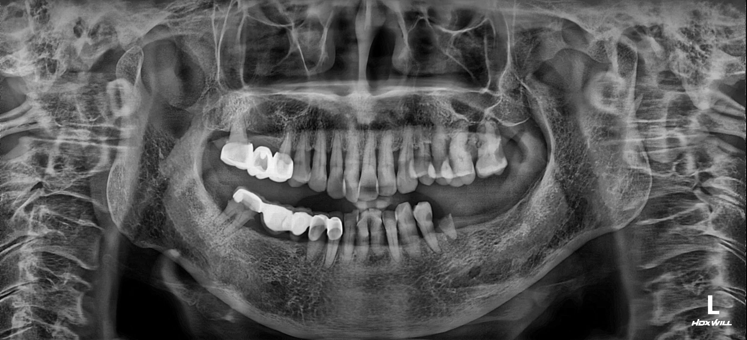 18. Comprehensive Geriatric Rehabilitation: Restoring Bilateral Function and Facial Symmetry