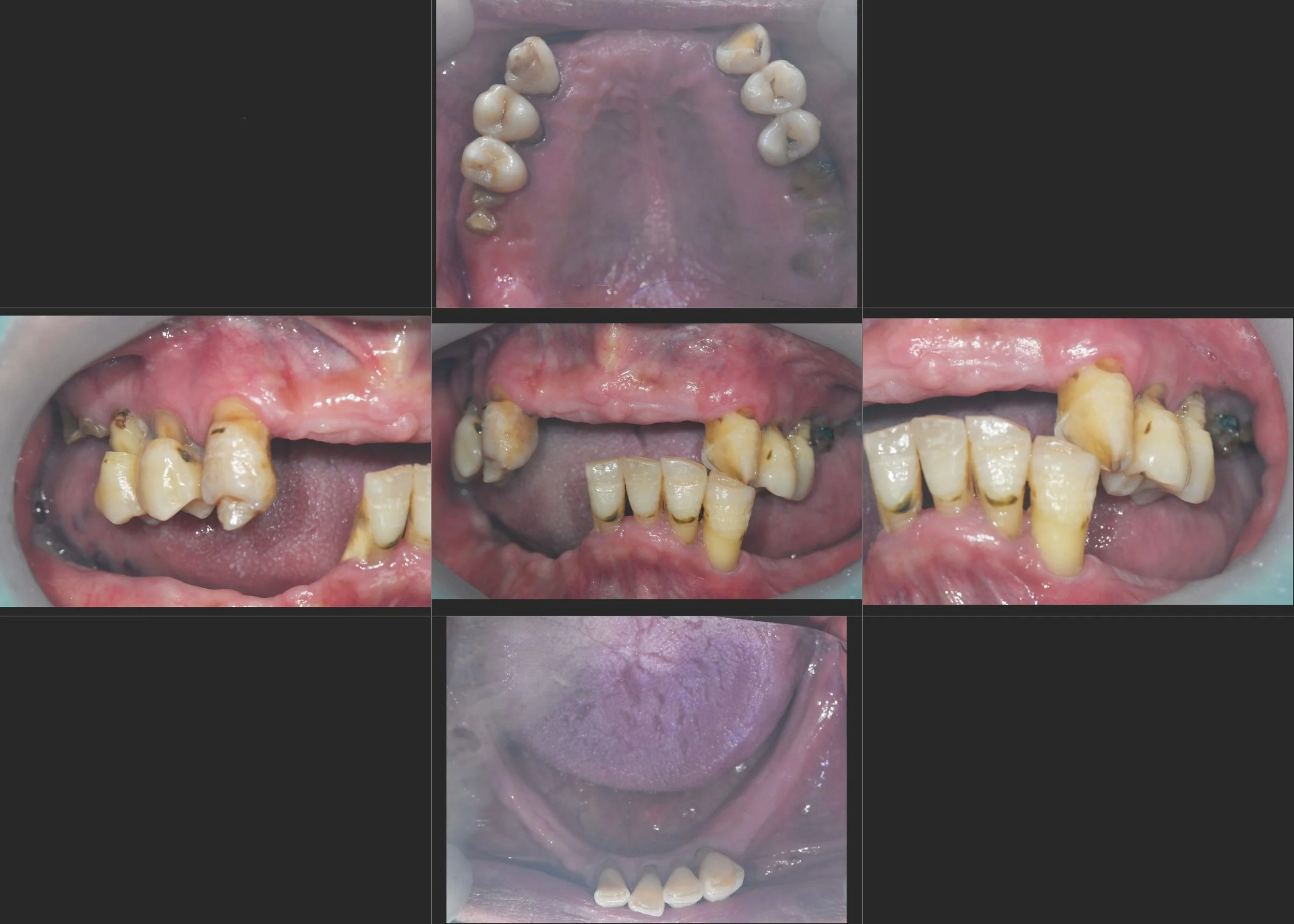 19. Systematic Full-Arch Rehabilitation: Balancing Implant Support and Natural Tooth Preservation