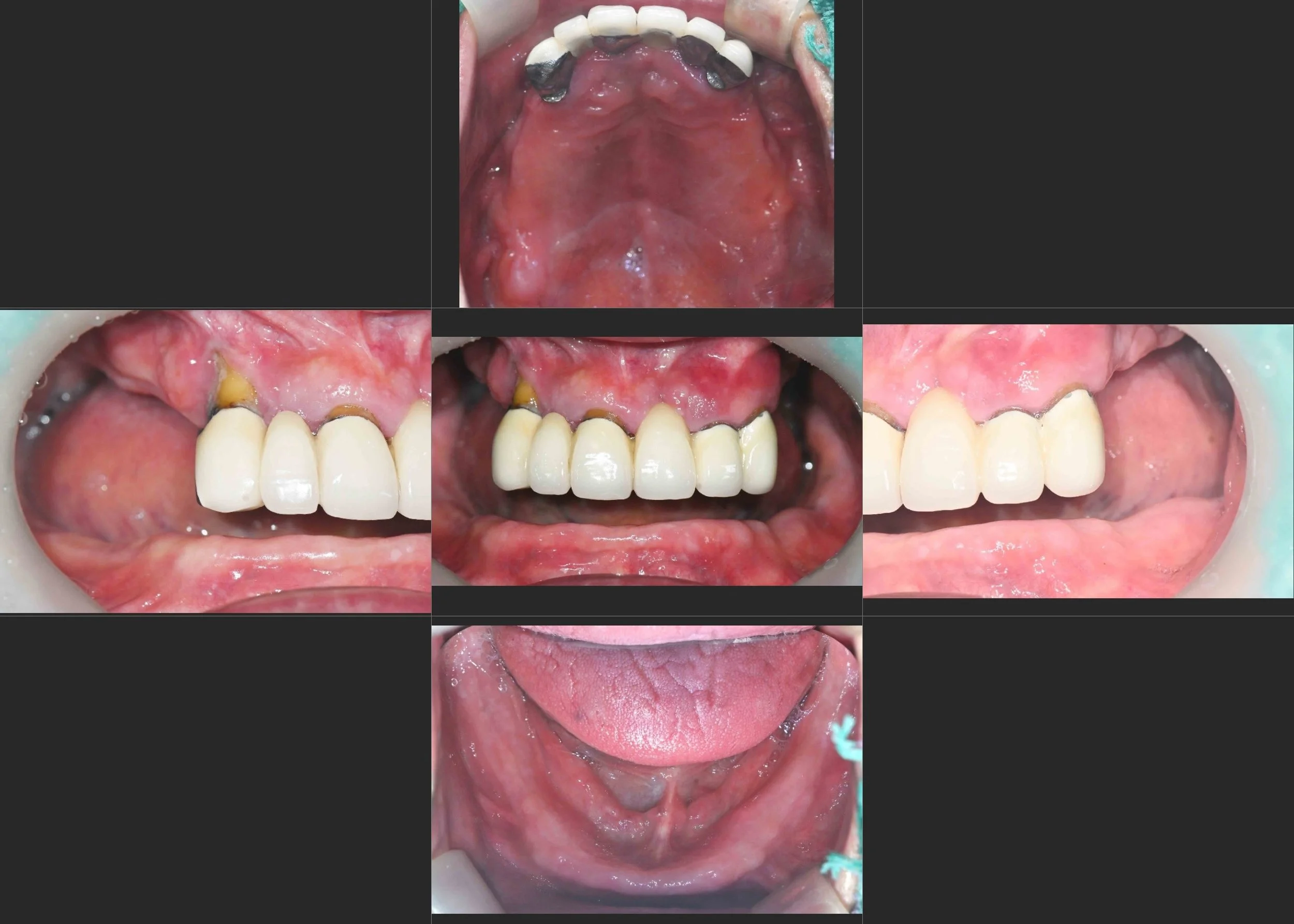 20. Definitive Full-Arch Rehabilitation: Transitioning from Removable Atrophy to Fixed Stability