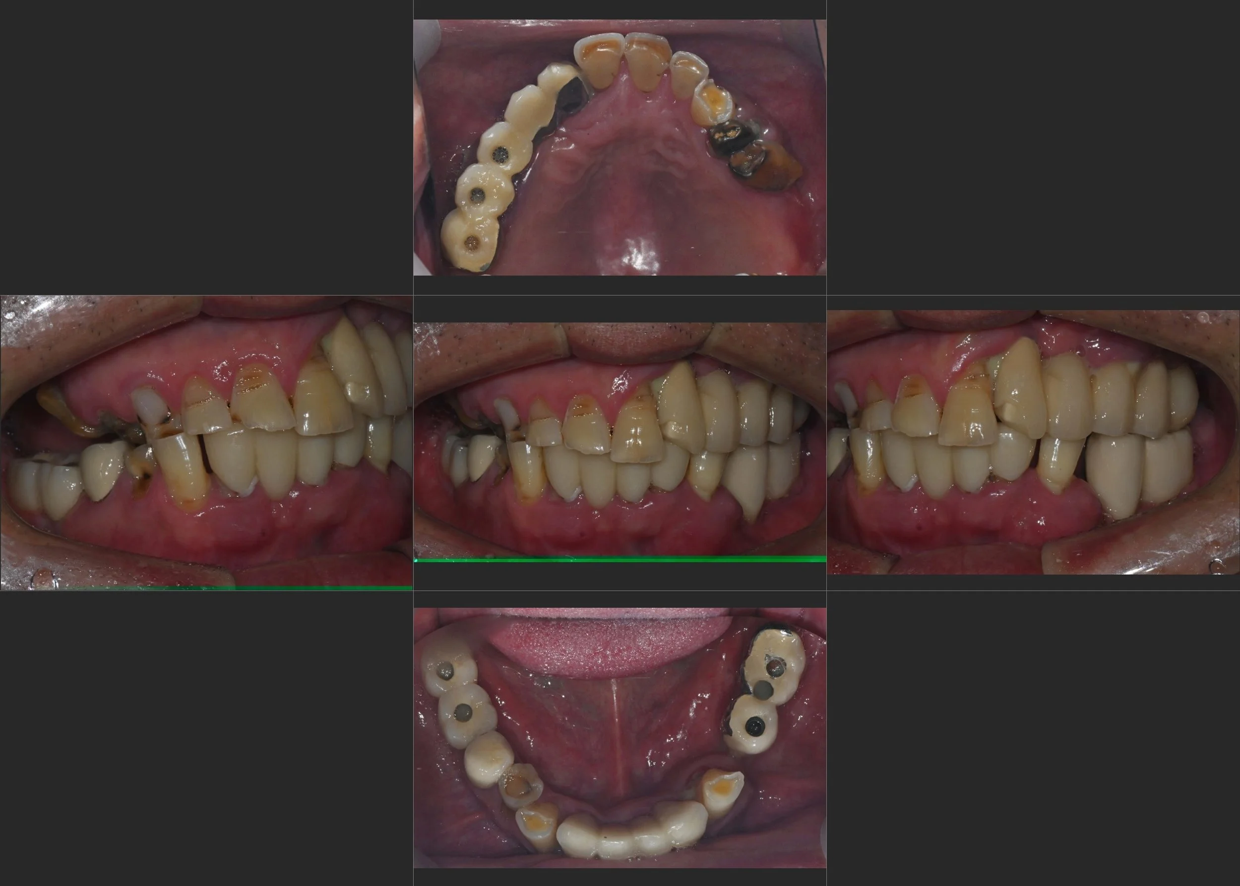 22. Strategic Phased Full-Arch Rehabilitation: Managing Mandibular Deviation