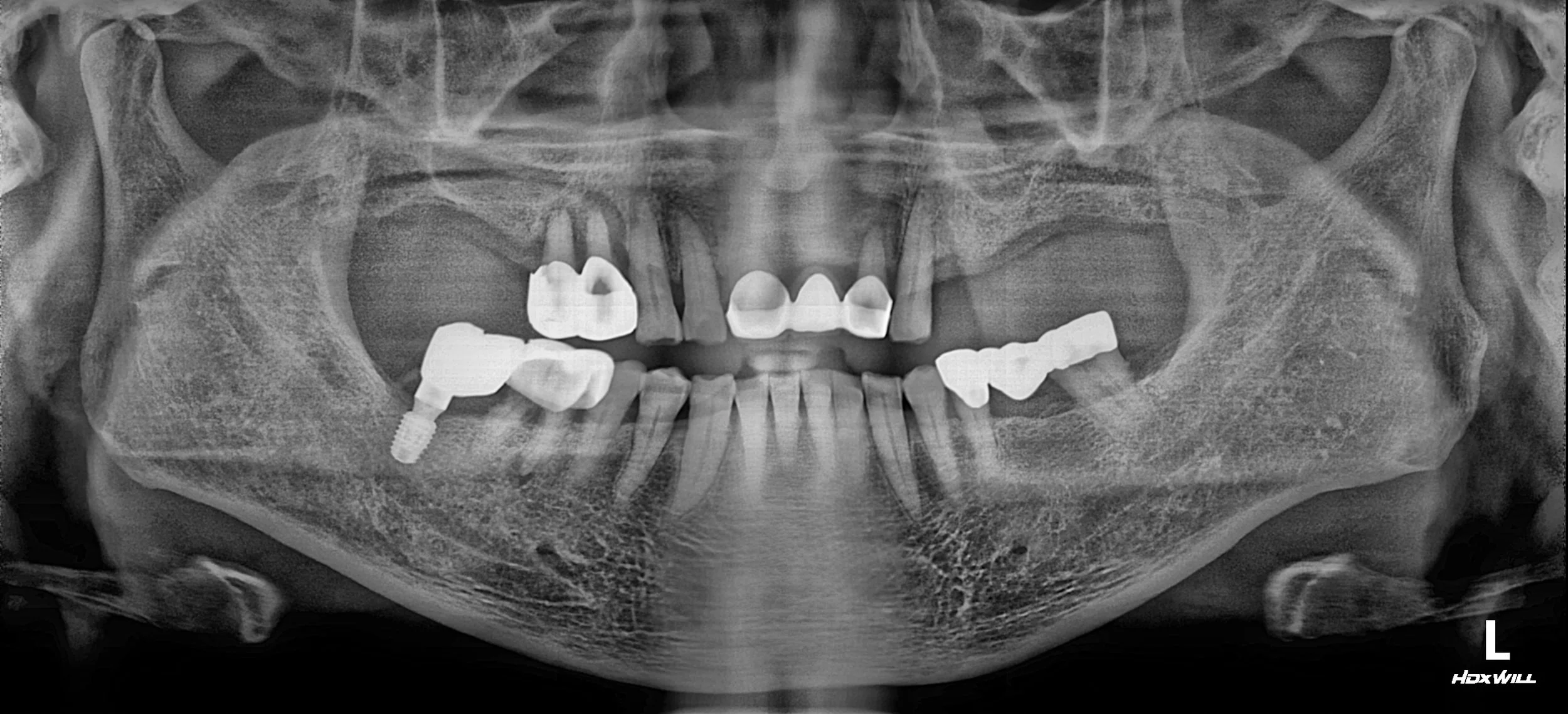 23. Restoring Function and Trust: Comprehensive Full-Mouth Rehabilitation