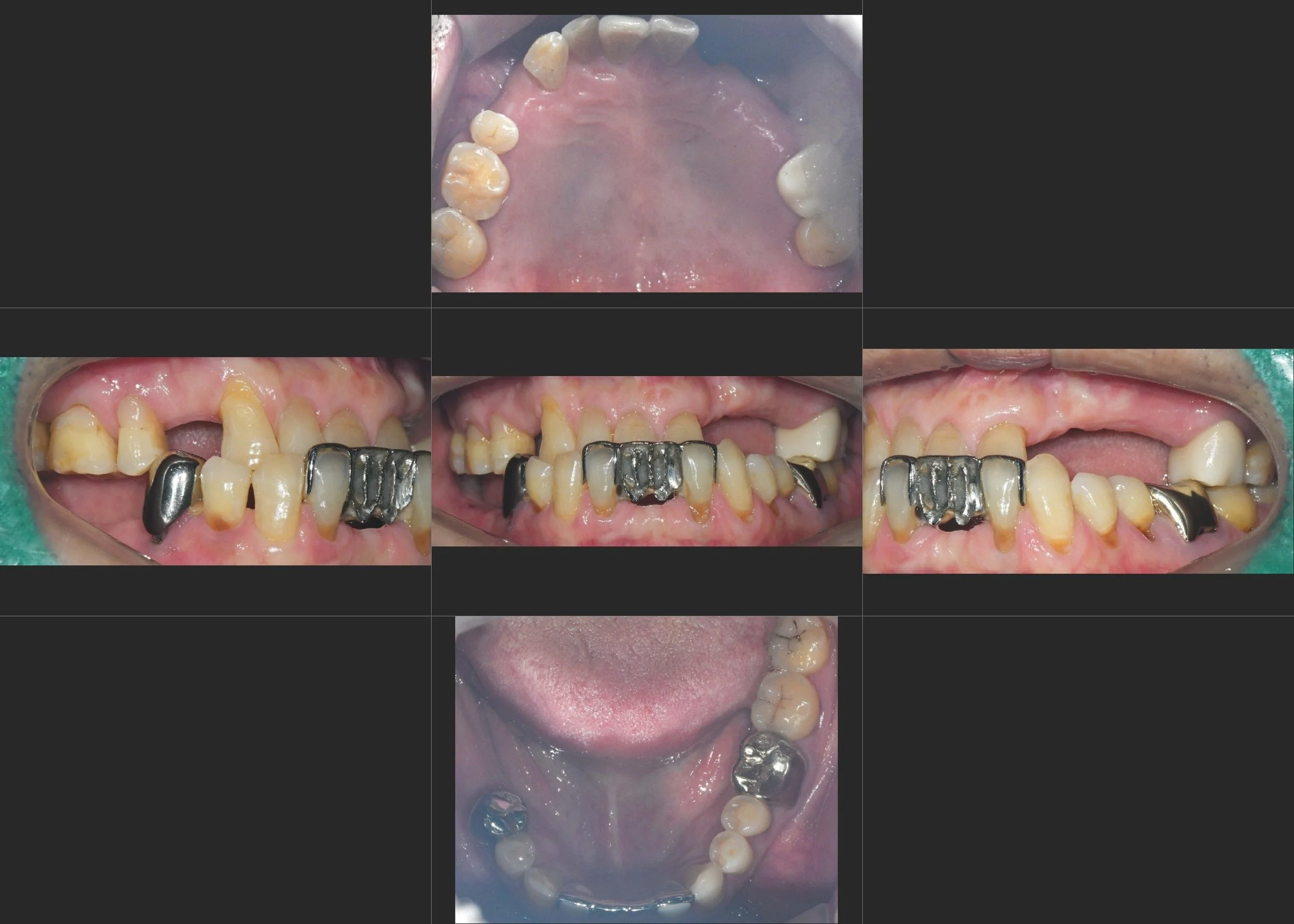 24. Comprehensive Rehabilitation of Class III Malocclusion: Correcting Mandibular Deviation