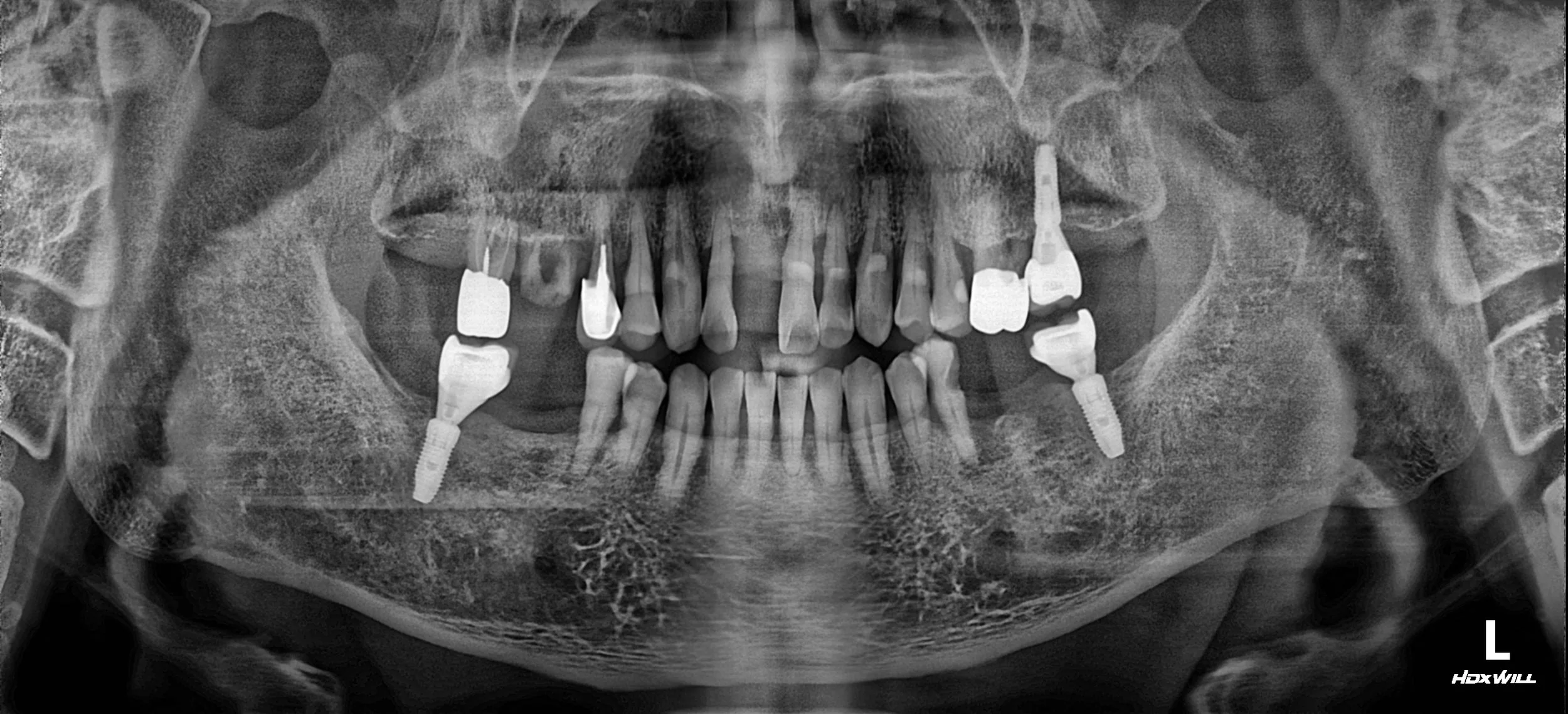25. Comprehensive Full-Arch Rehabilitation: Re-establishing Occlusal Harmony in Advanced Periodontitis