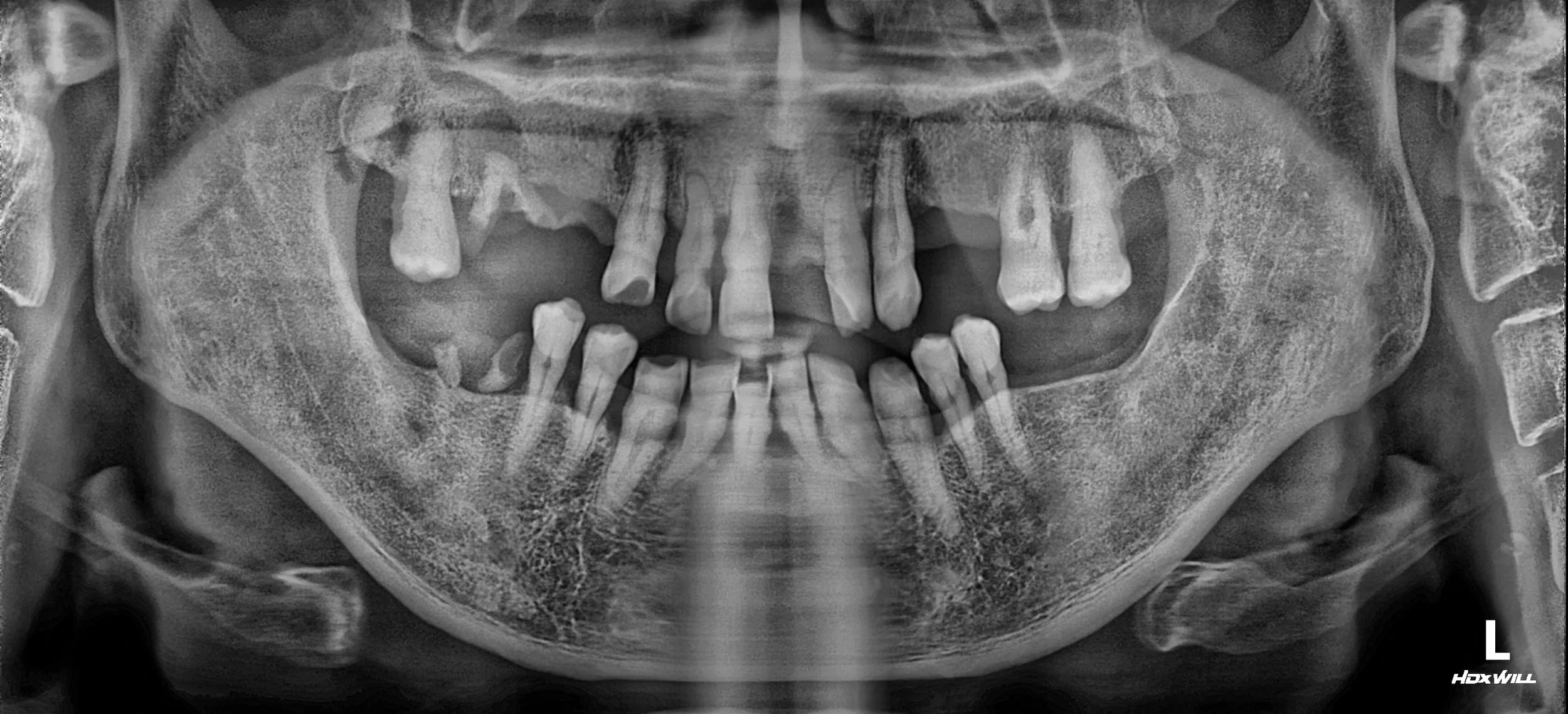 26. Strategic Tooth Preservation in Full-Arch Rehabilitation