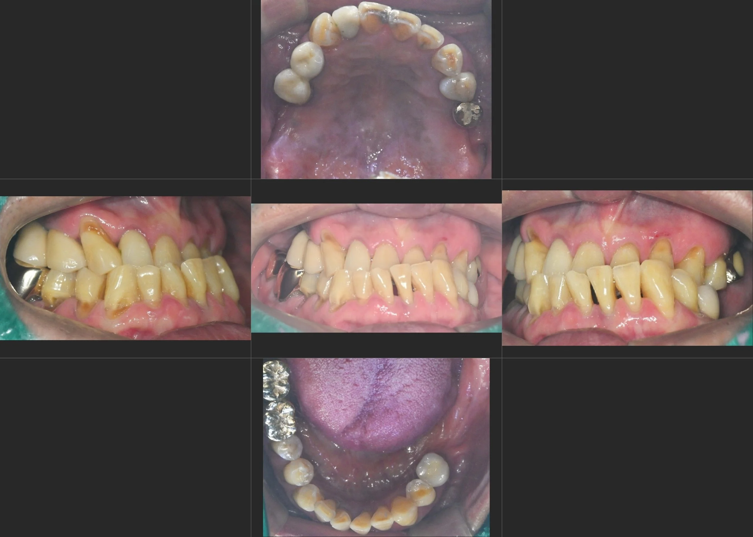 27. Non-Surgical Correction of Severe Malocclusion and Facial Asymmetry