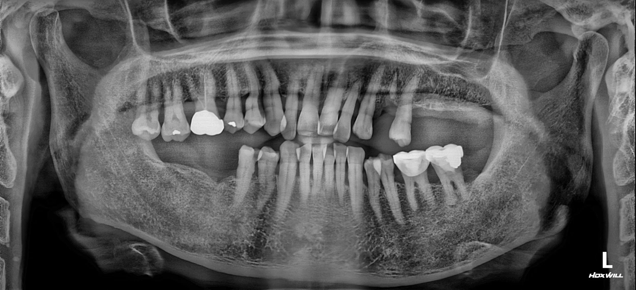 30. Strategic Full Mouth Rehabilitation: Balancing Clinical Goals and Financial Constraints