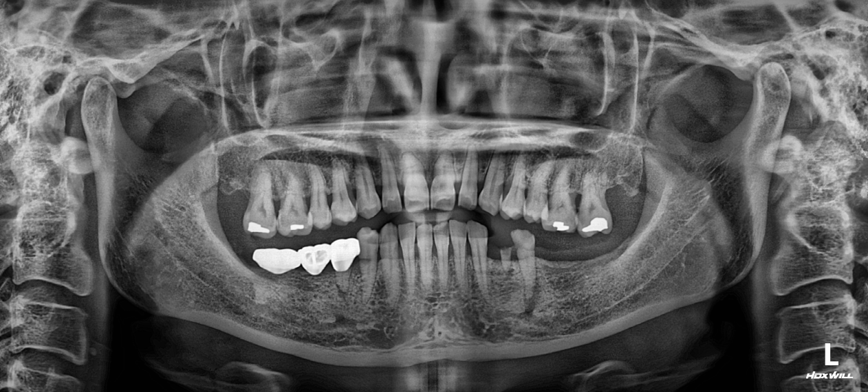 28. Posterior Occlusal Rehabilitation with Natural Anterior Preservation