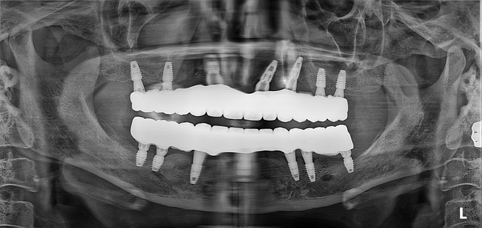 31. Full-Arch All-on-6 Rehabilitation: Overcoming Severe Bone Atrophy and Flabby Tissue