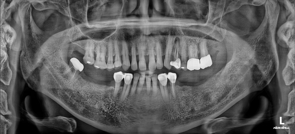 29. Full Mouth Rehabilitation: Restoring Mandibular Position and Occlusal Balance
