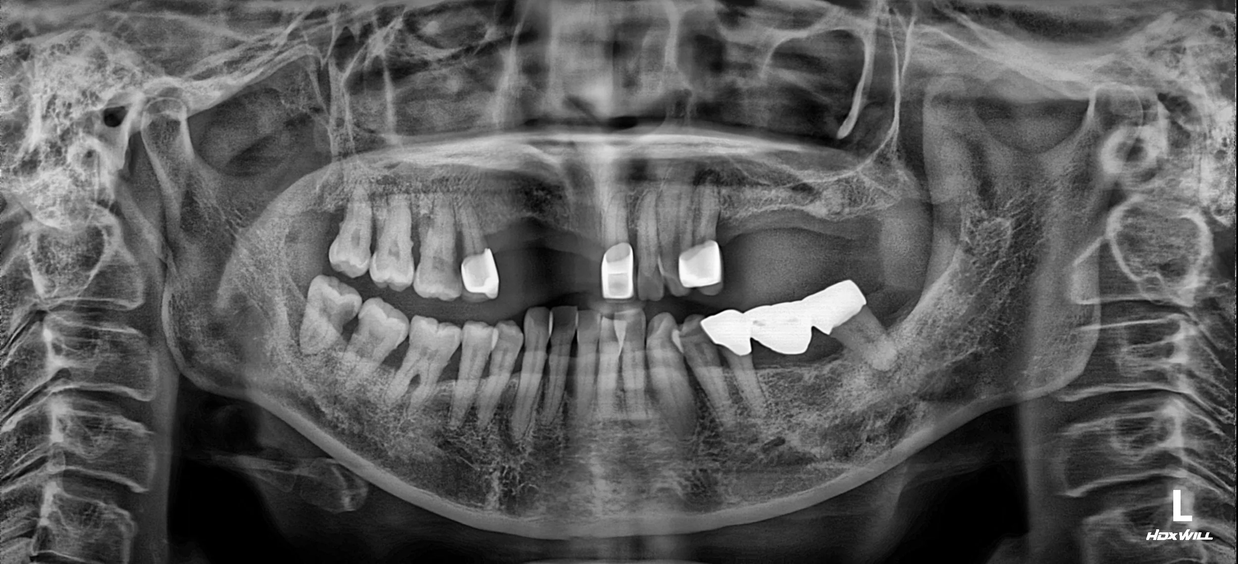 32. Strategic Phased Rehabilitation: Managing Severe Alveolar Atrophy