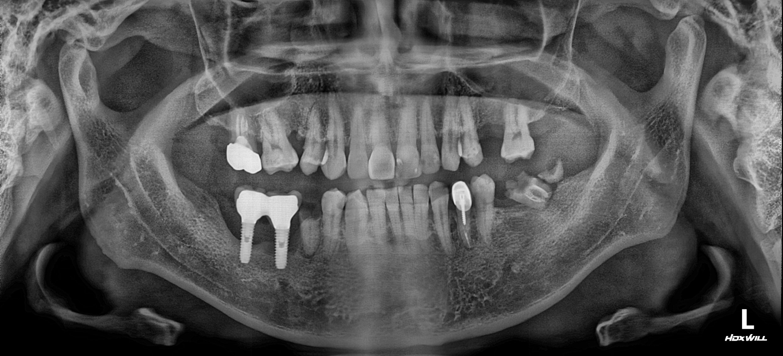 33. Comprehensive Revision Therapy: Reclaiming Function from Multiple Implant Failures