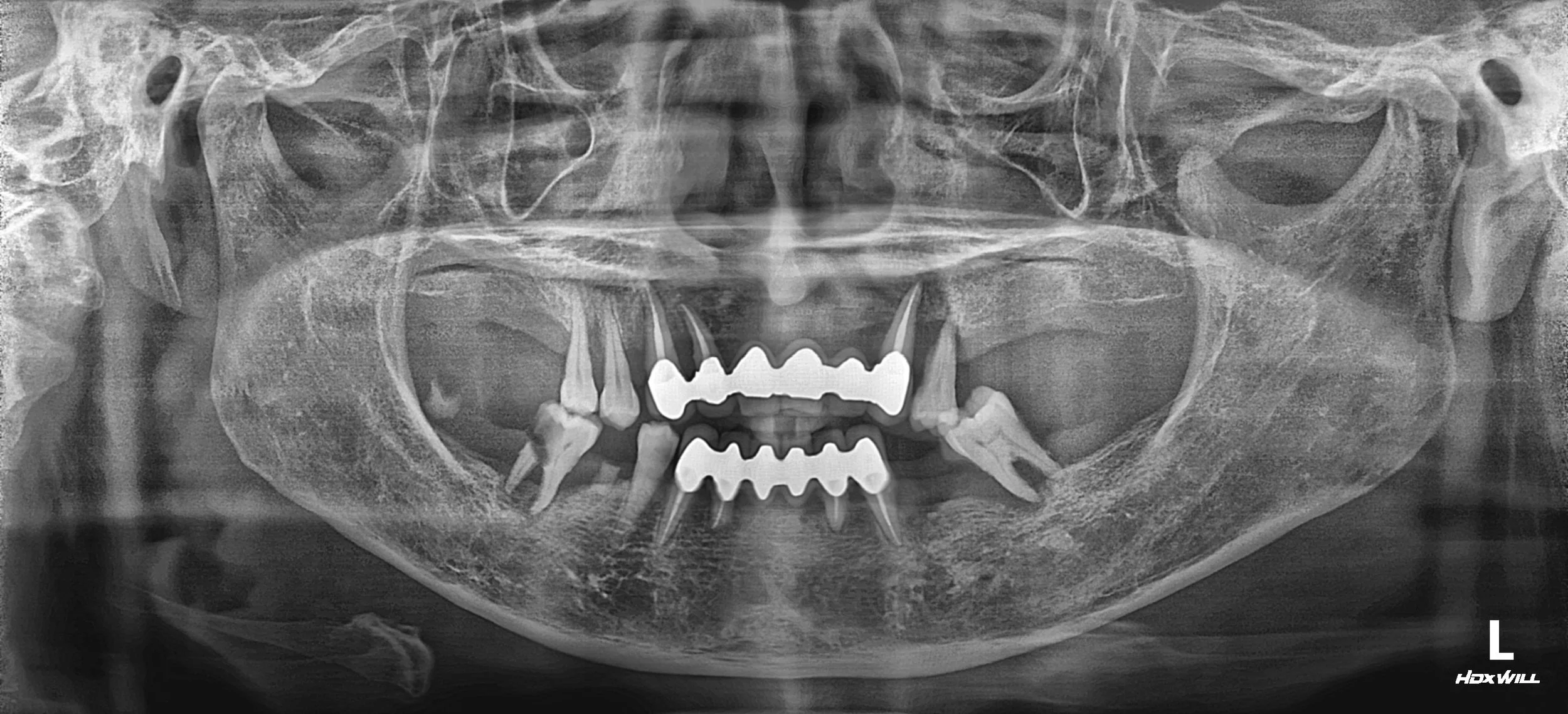 34. Comprehensive Full-Arch Implant Rehabilitation: A Maintenance-First Approach