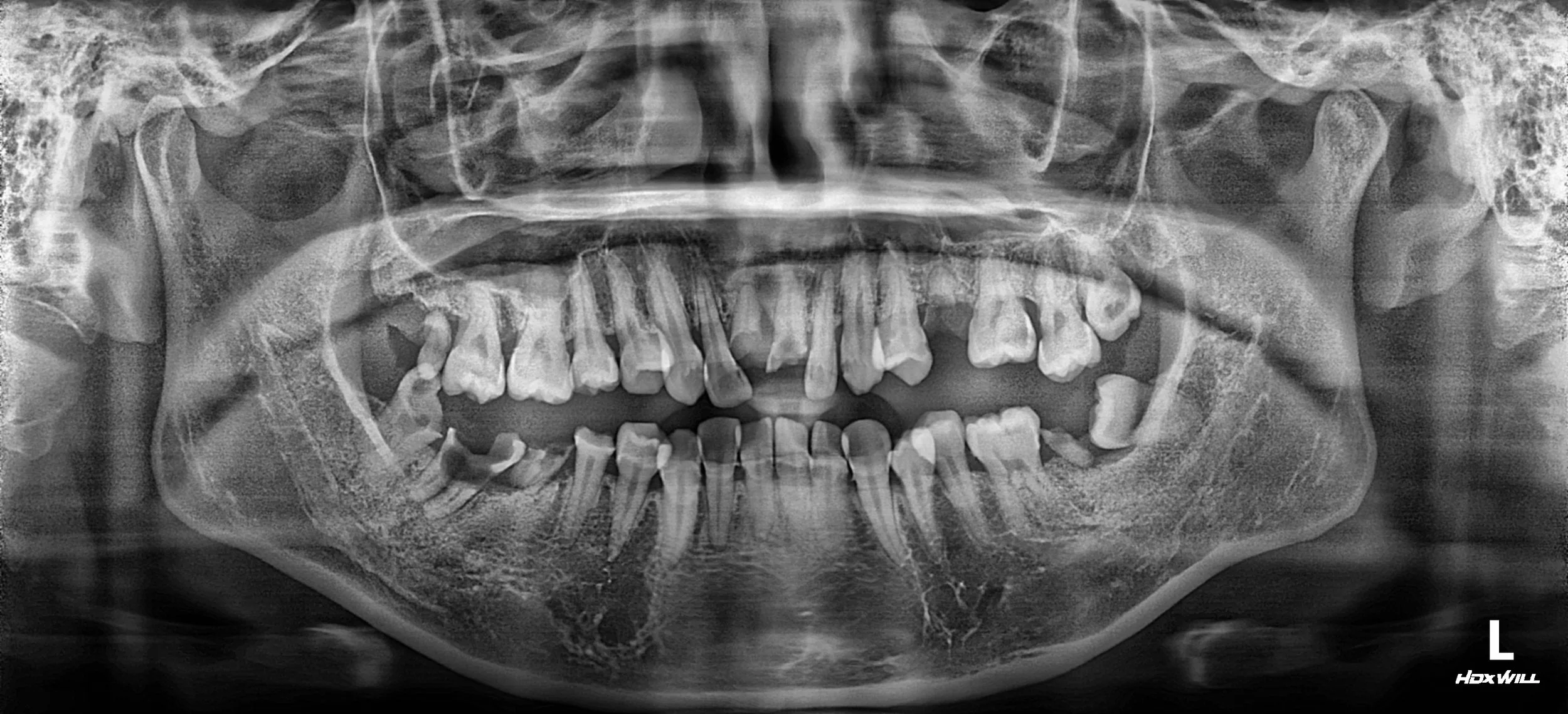 35. Comprehensive Full-Arch Transformation: Restoring Confidence in a Young Phobic Patient