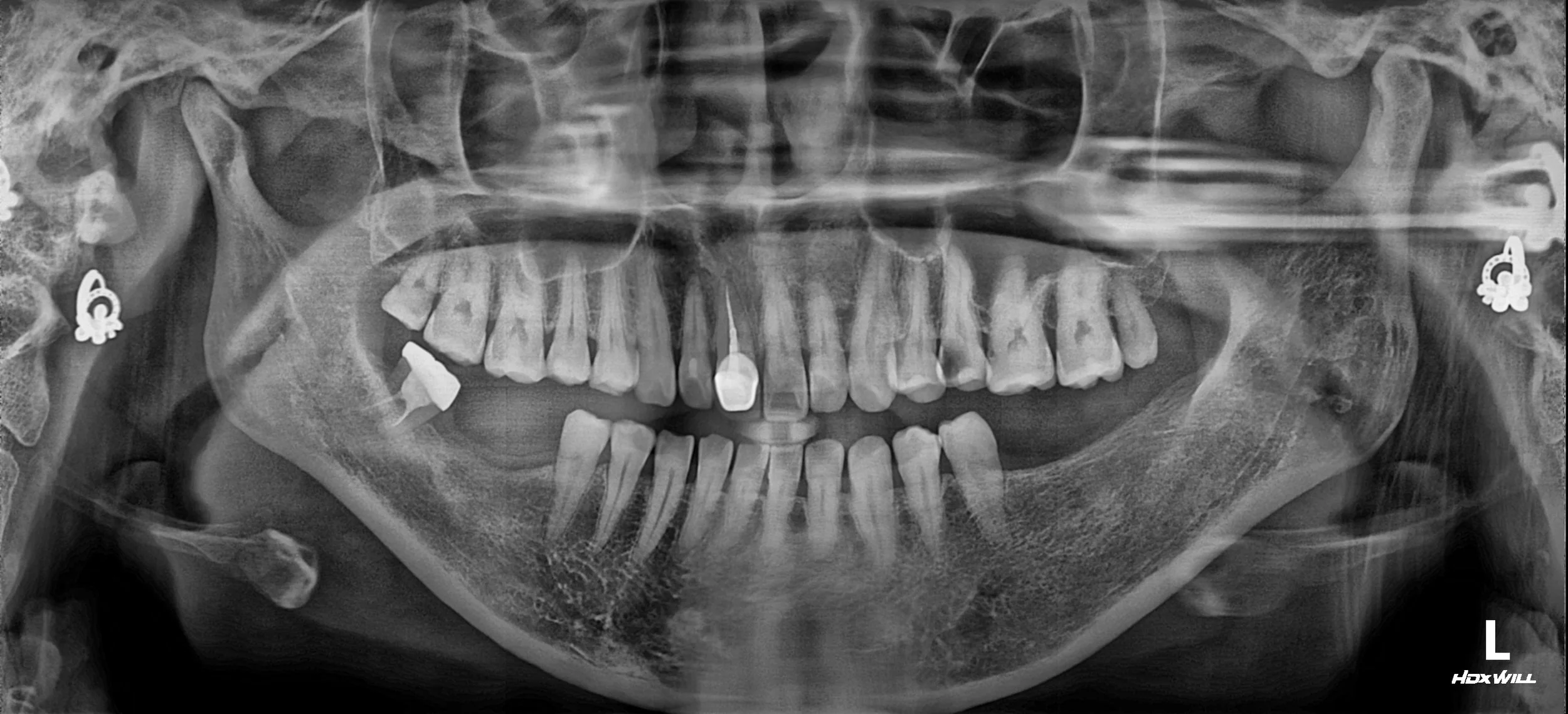 36. Functional Correction of Mandibular Deviation and TMJ Distress