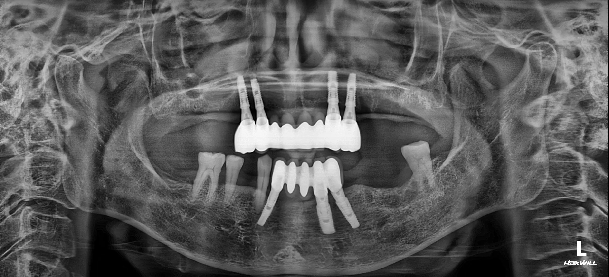 37. Reclaiming Functional Comfort: Correcting Iatrogenic Occlusal Failure
