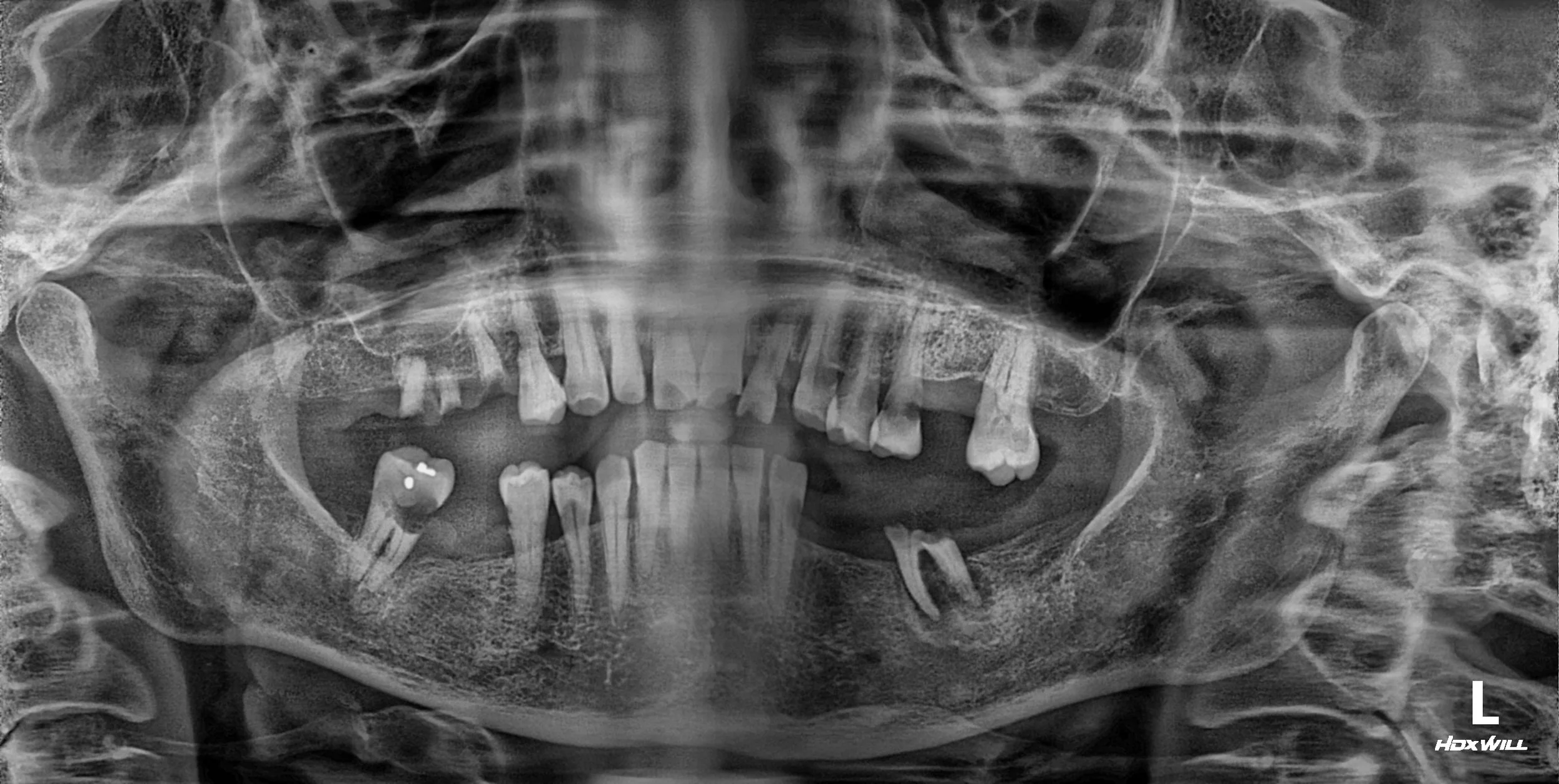 38. Comprehensive Full-Arch Reconstruction: Reversing the Domino Effect of Tooth Loss