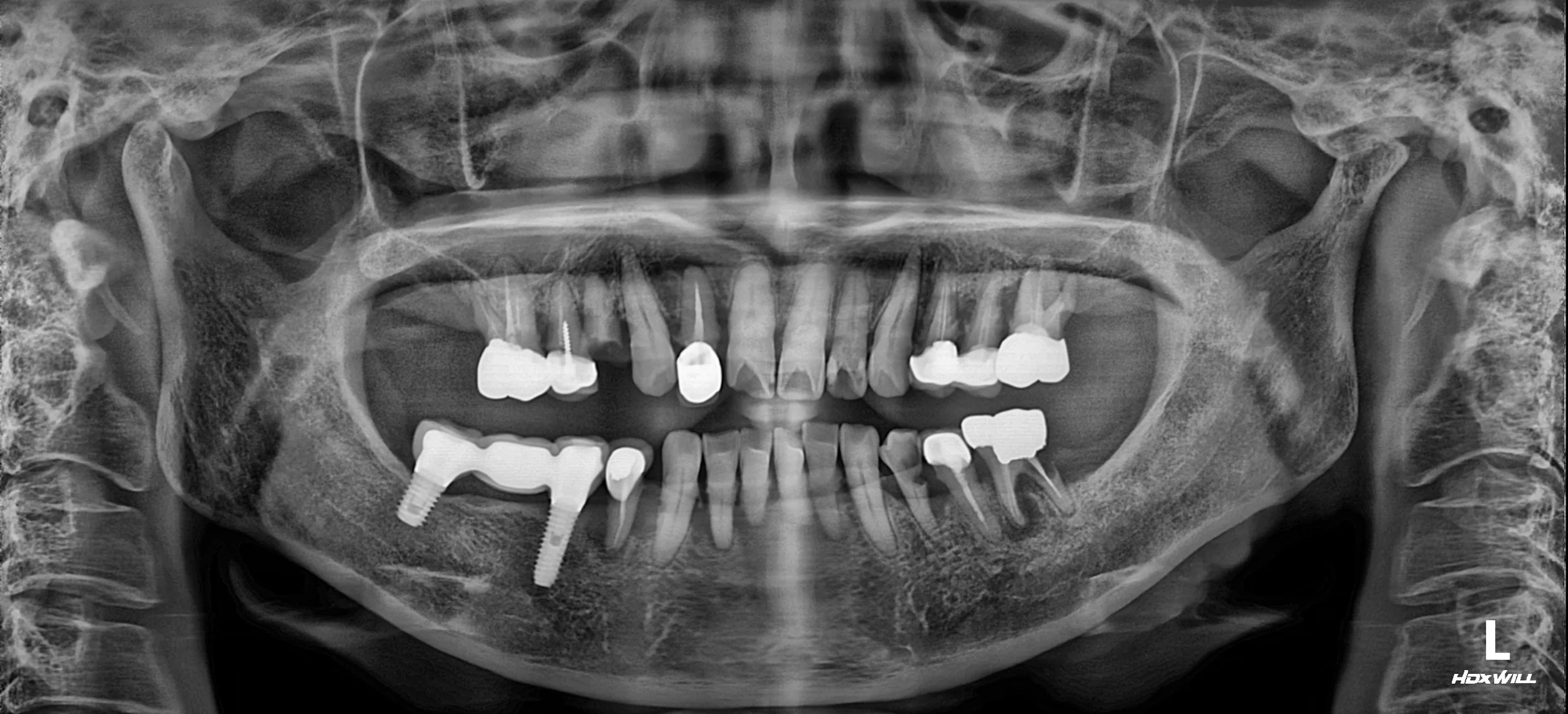 39. Comprehensive Full-Arch Rehabilitation: Overcoming Severe Bone Atrophy and Occlusal Collapse