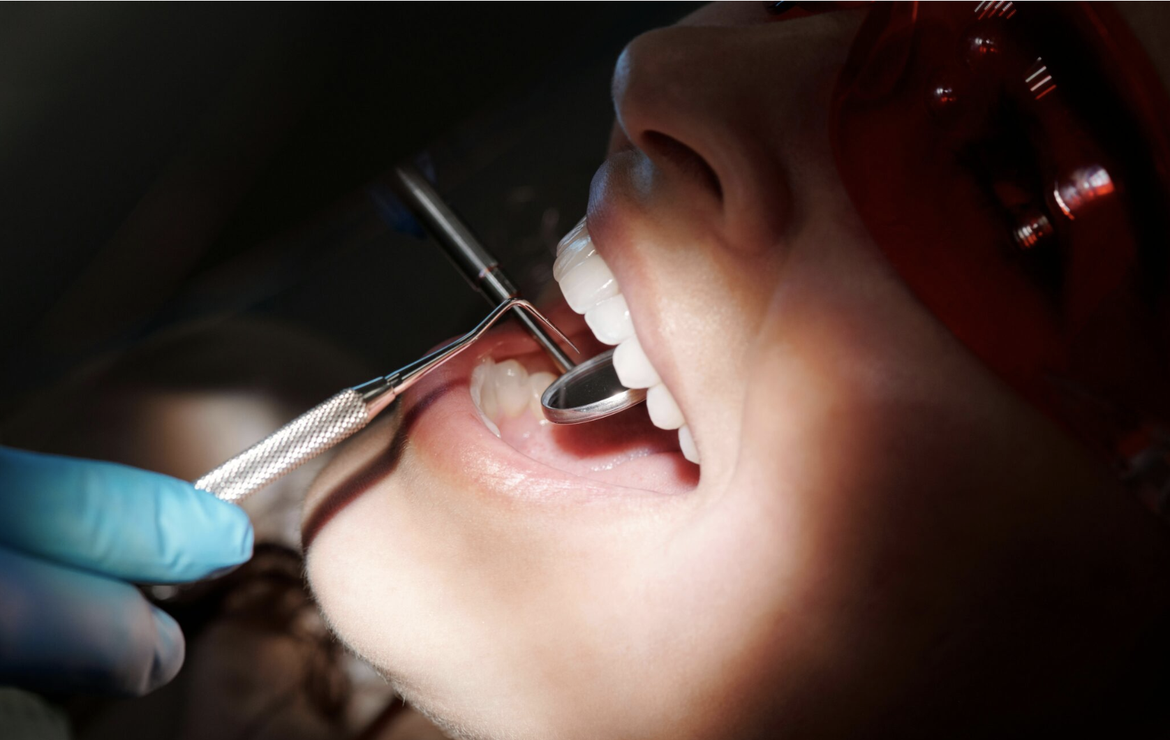 Como Surgiram as Facetas Dentárias