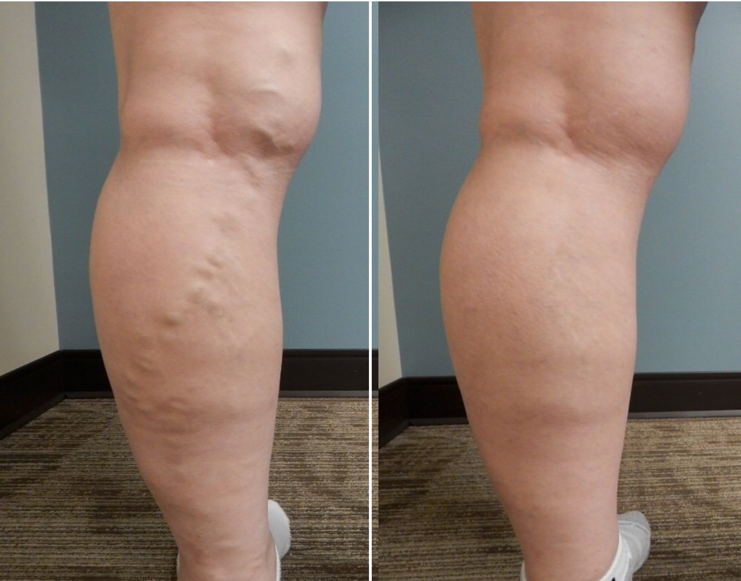 Small saphenous treatment with complicated behind-the-knee access: Before and After