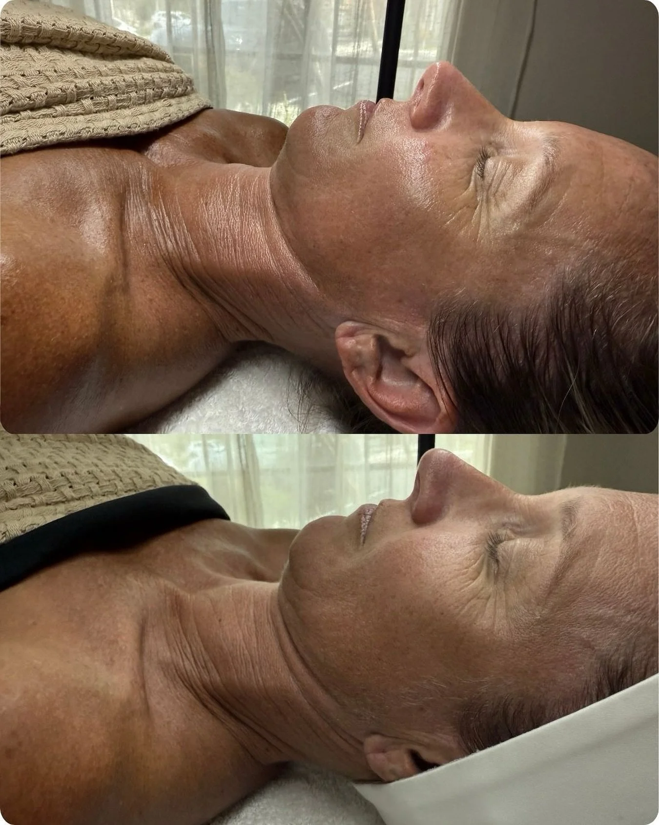 From dry to deeply hydrated.
This beauty came in looking for a boost in hydration and glow&mdash;and that&rsquo;s exactly what we delivered.

Service: The Enhanced Facial
A 60-minute treatment that includes:
	&bull;	Dermaplaning to gently exfoliate a