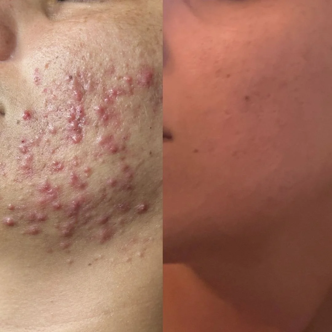 acne expert florida.jpg