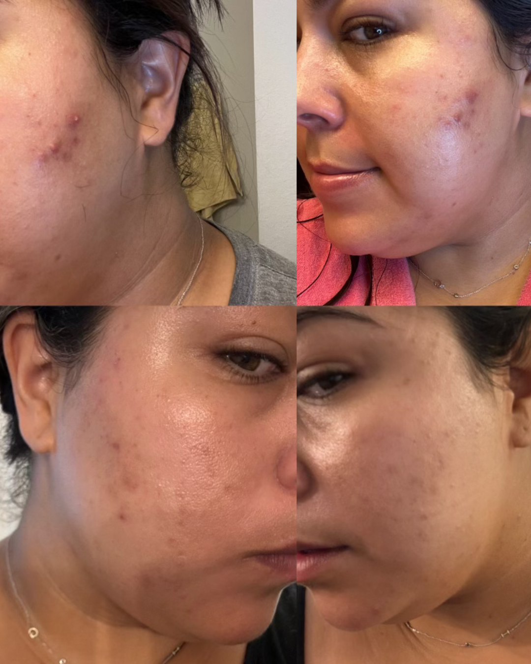 estero acne facial.png
