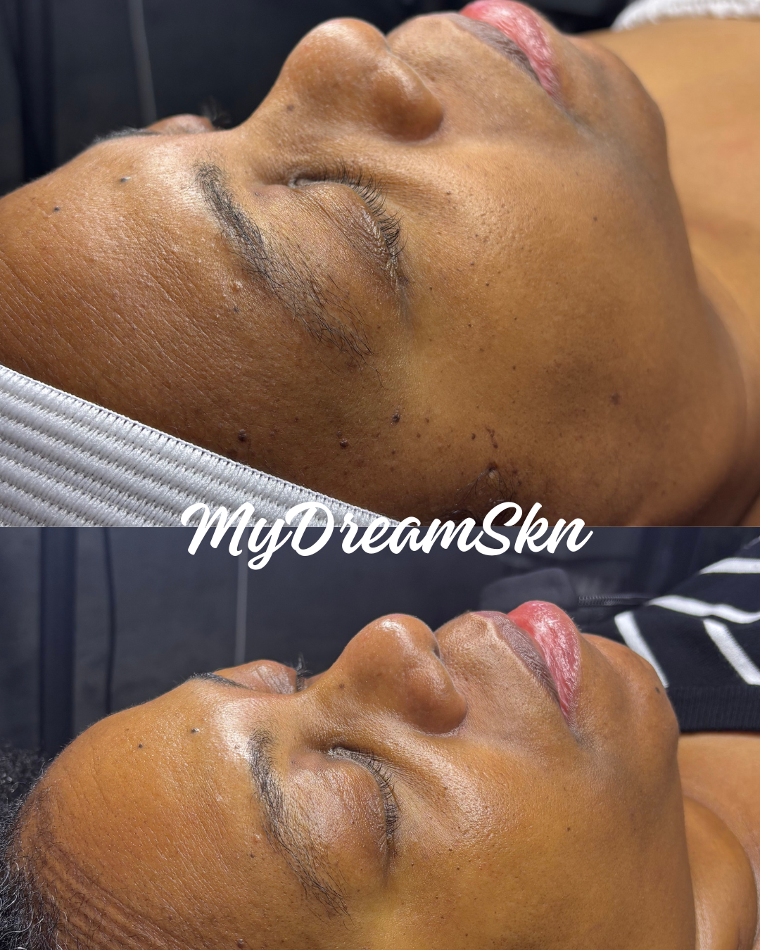 Before and after images showing a person's face post-skincare treatment, with visibly improved skin clarity, reduced pimples, and a smoother complexion.