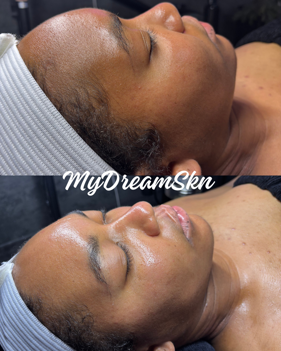 Side-by-side comparison of a woman's face before and after a skincare treatment, showing improved skin tone and texture.