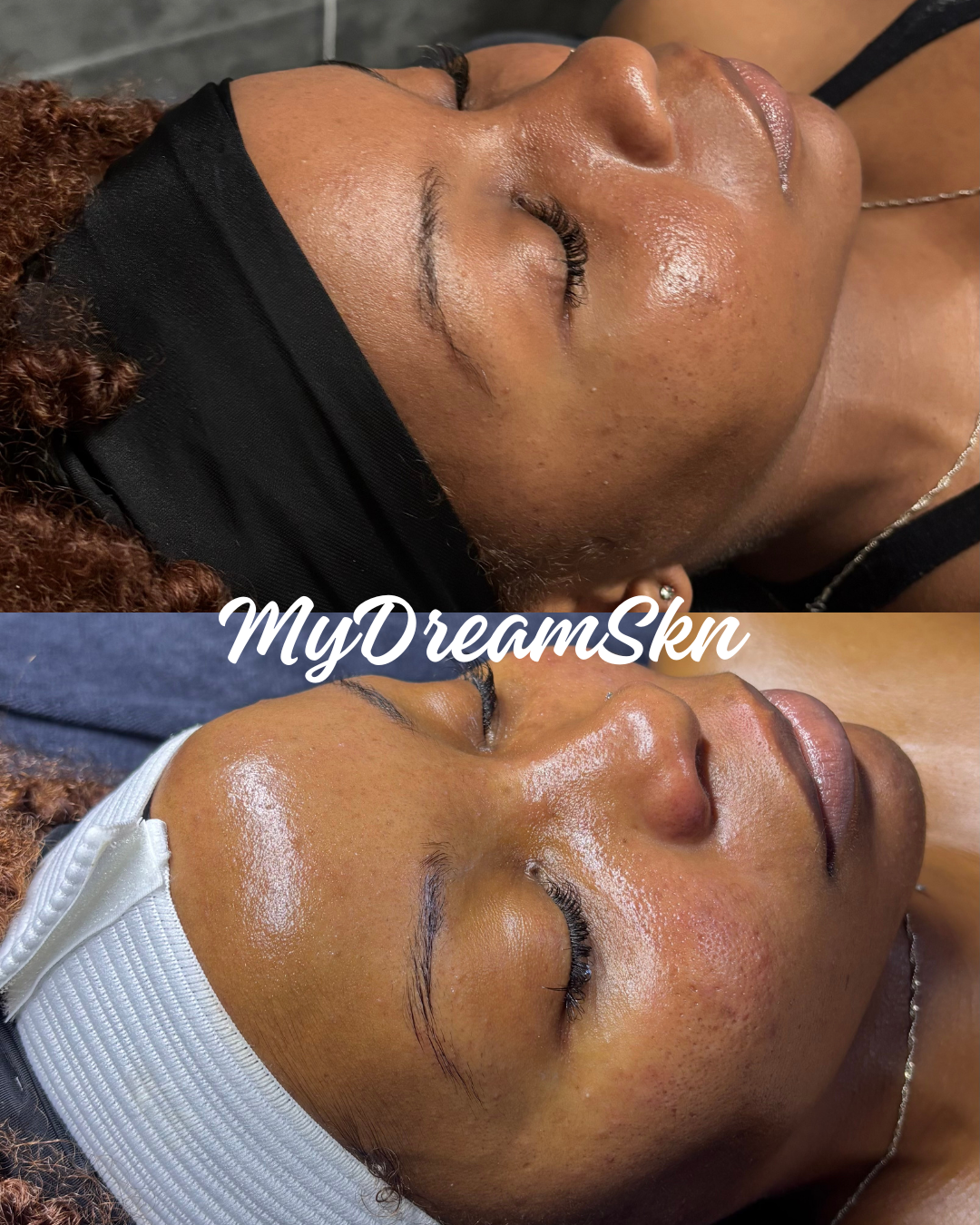 Before and after images of a woman receiving skincare treatment, showing improvements in skin texture and appearance with the watermark 'MyDreamSkn'.