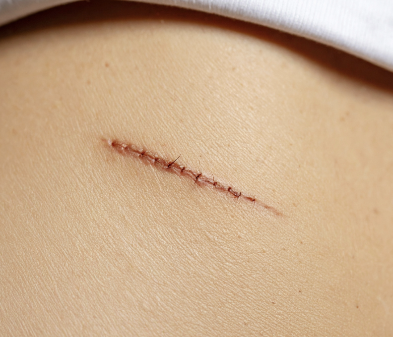 Close-up of a healing surgical scar with stitches on a person's skin.