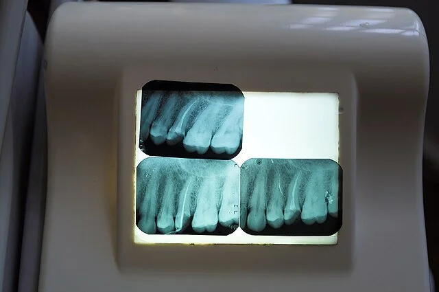 An x-ray of teeth.