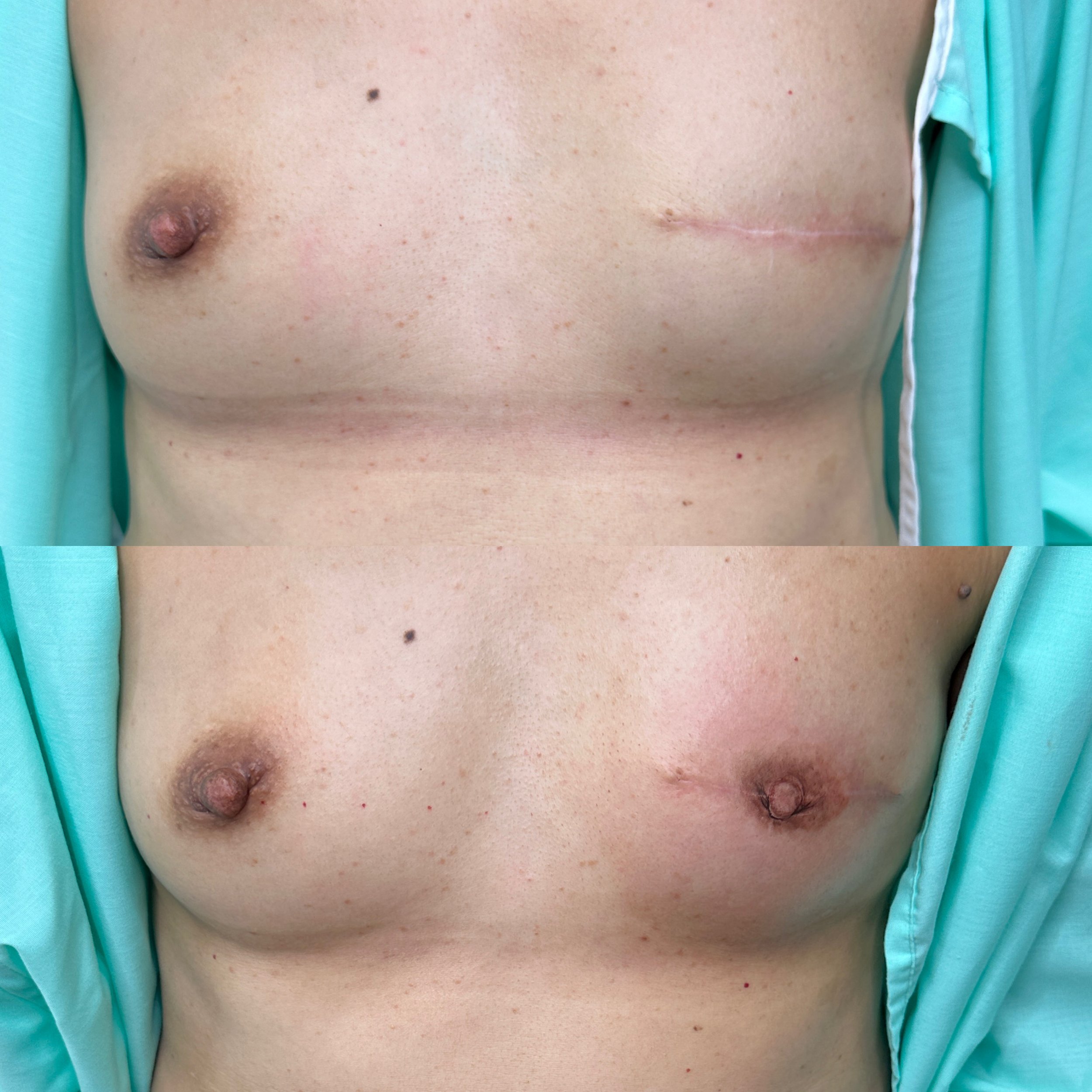 Online and In Person Training in 3D Areola Tattooing for Physicians