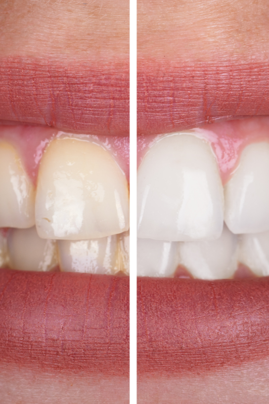 Teeth Whitening