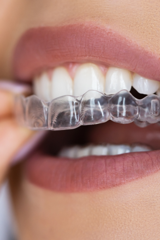 Invisalign