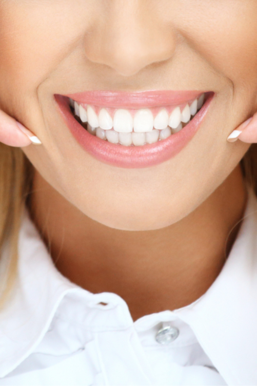 Veneers