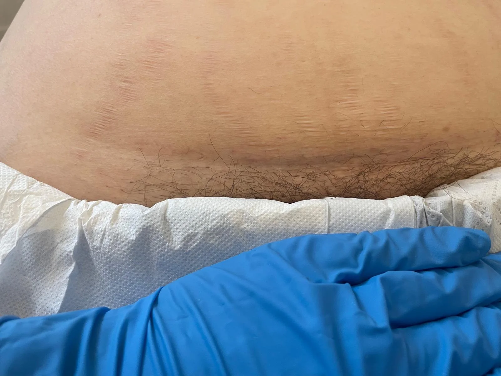 Scars, scar treatment and things that can help