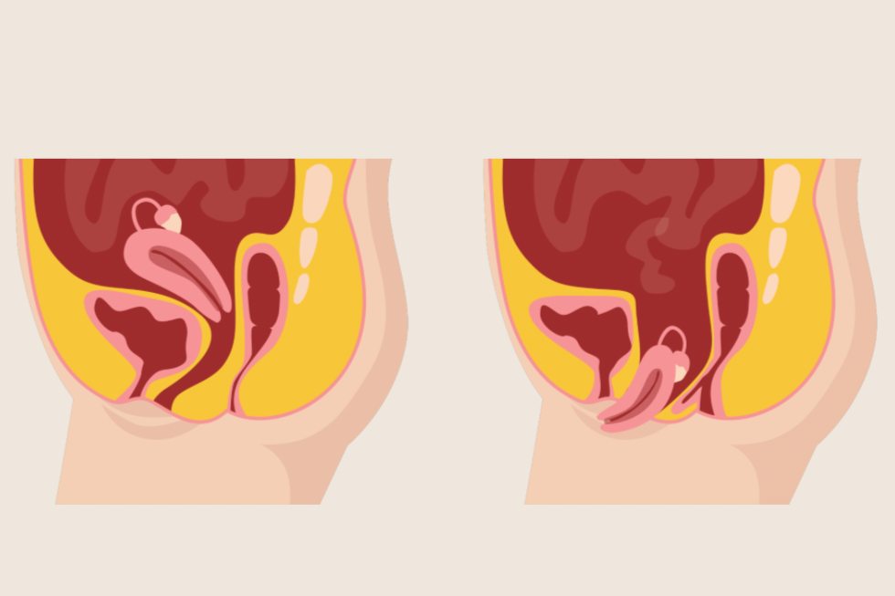 What is a normal vagina and prolapsed bladder showing a prolapse of the uterus down the vagina.