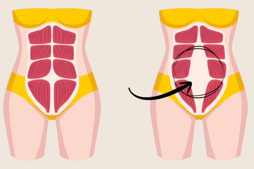 Abdominal muscles showing a diastasis recti or abdominal muscle separation. Common diastasis in pregnancy. Separated belly muscles. The separation of the abdomen when a woman becomes pregnant. Tummy gap seen.