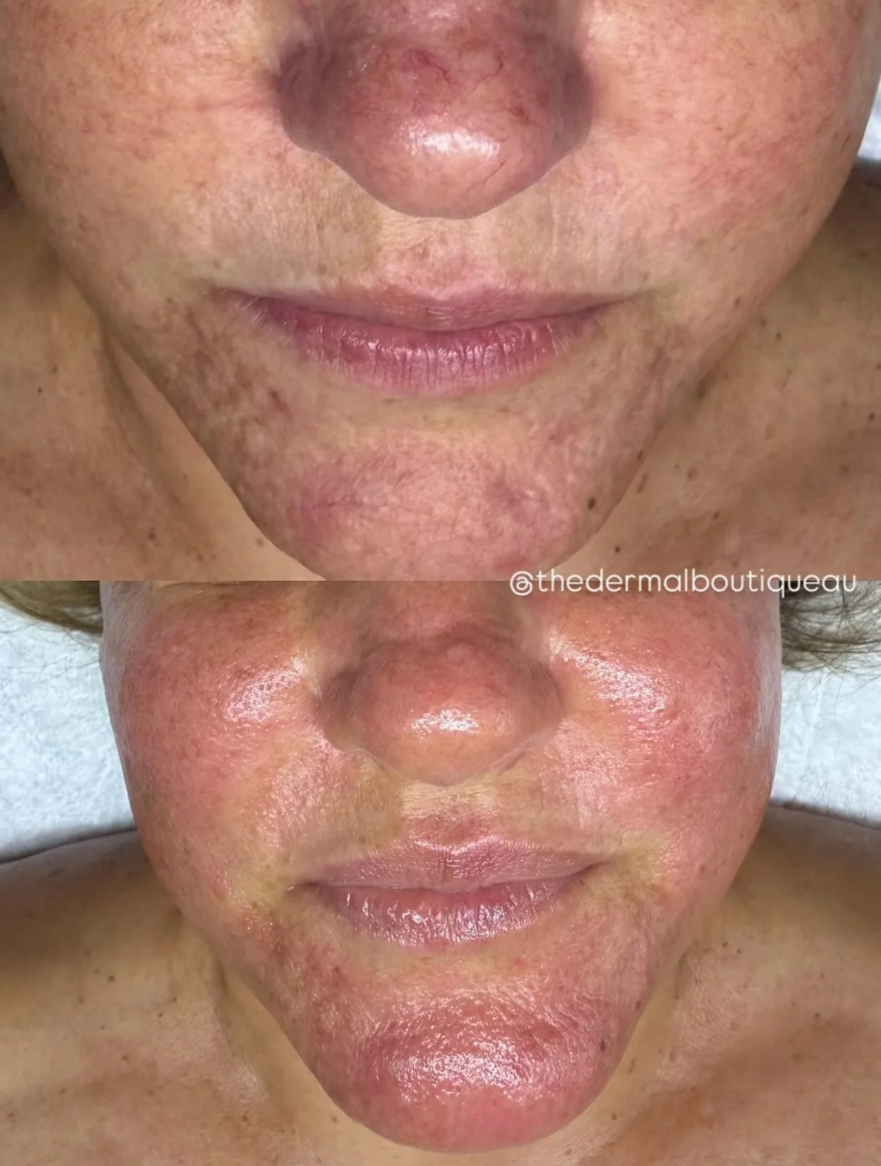 Before &rarr; After ✨
Our patient presented with a more aggressive form of rosacea, characterised by persistent facial erythema, visible superficial capillaries and compromised skin barrier function.

Her treatment journey has included the use of the