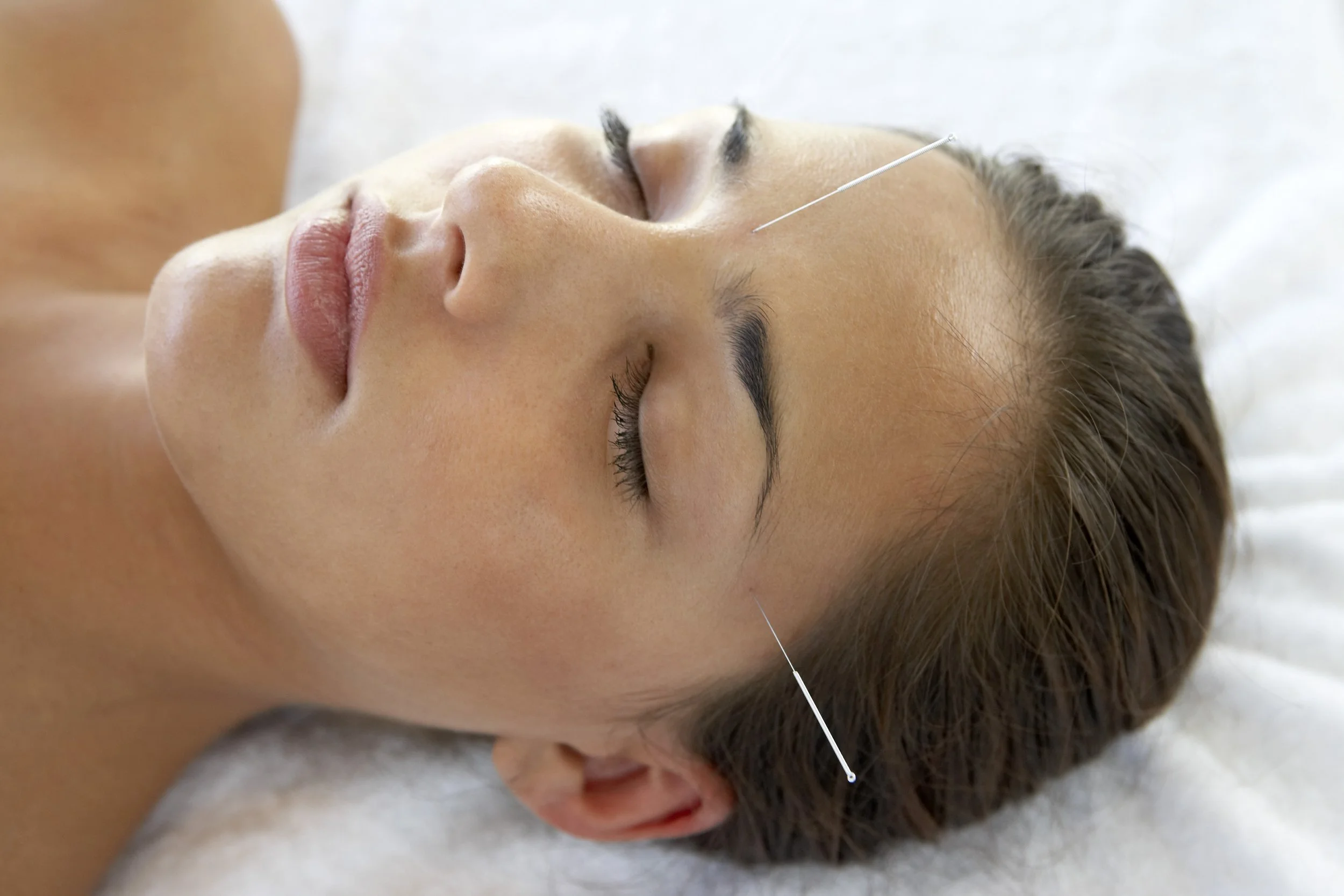 Holistic Facial Acupuncture