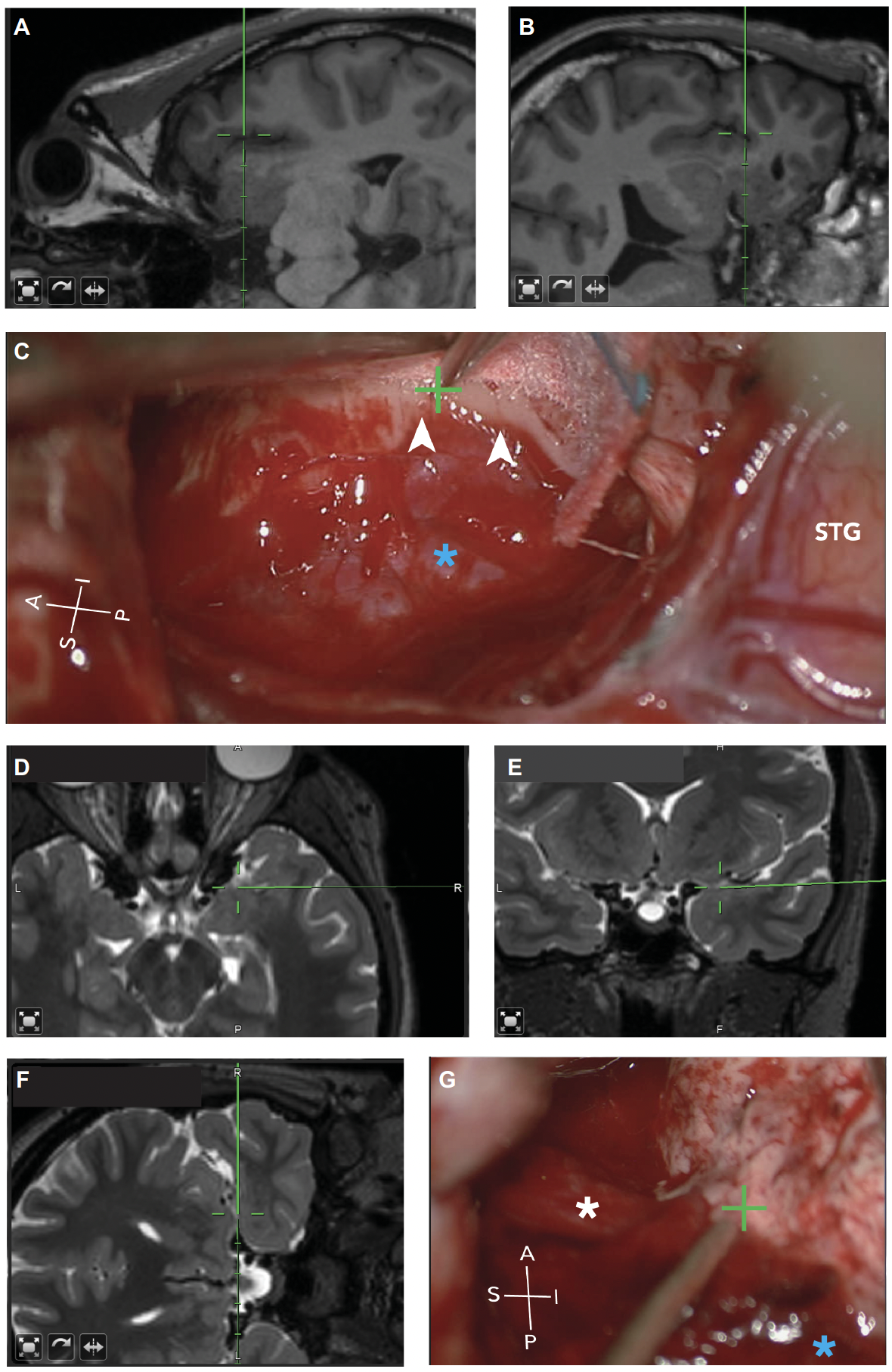 Epilepsy Surgery — Brain Modulation Lab