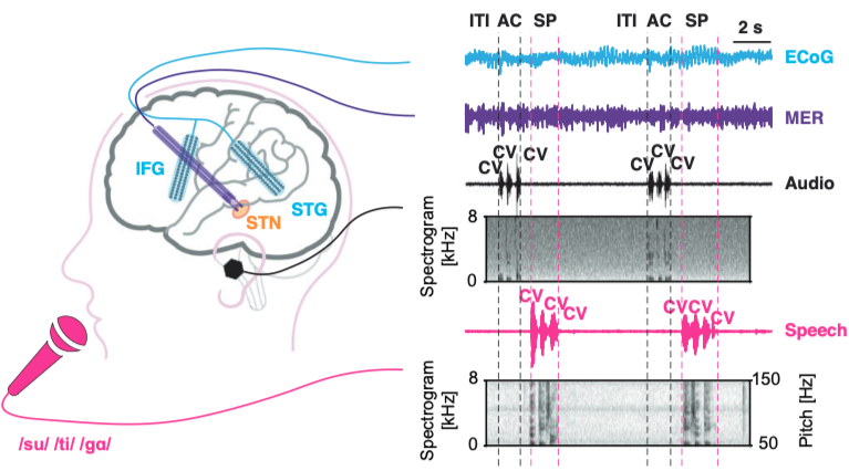 intracranial subthalamic and cortical recording during speech  