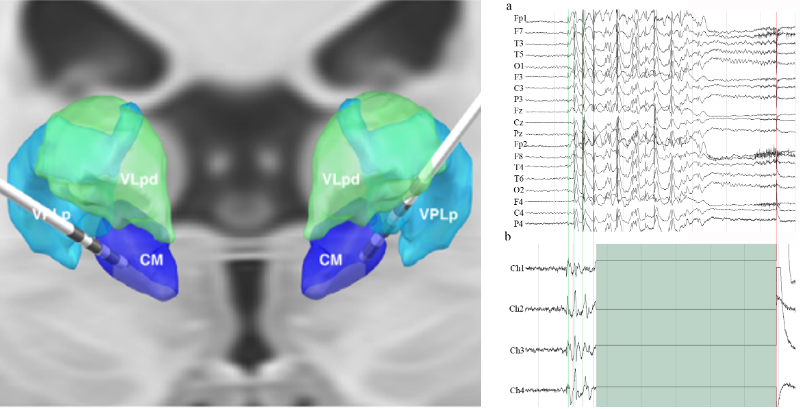 BML Projects — Brain Modulation Lab