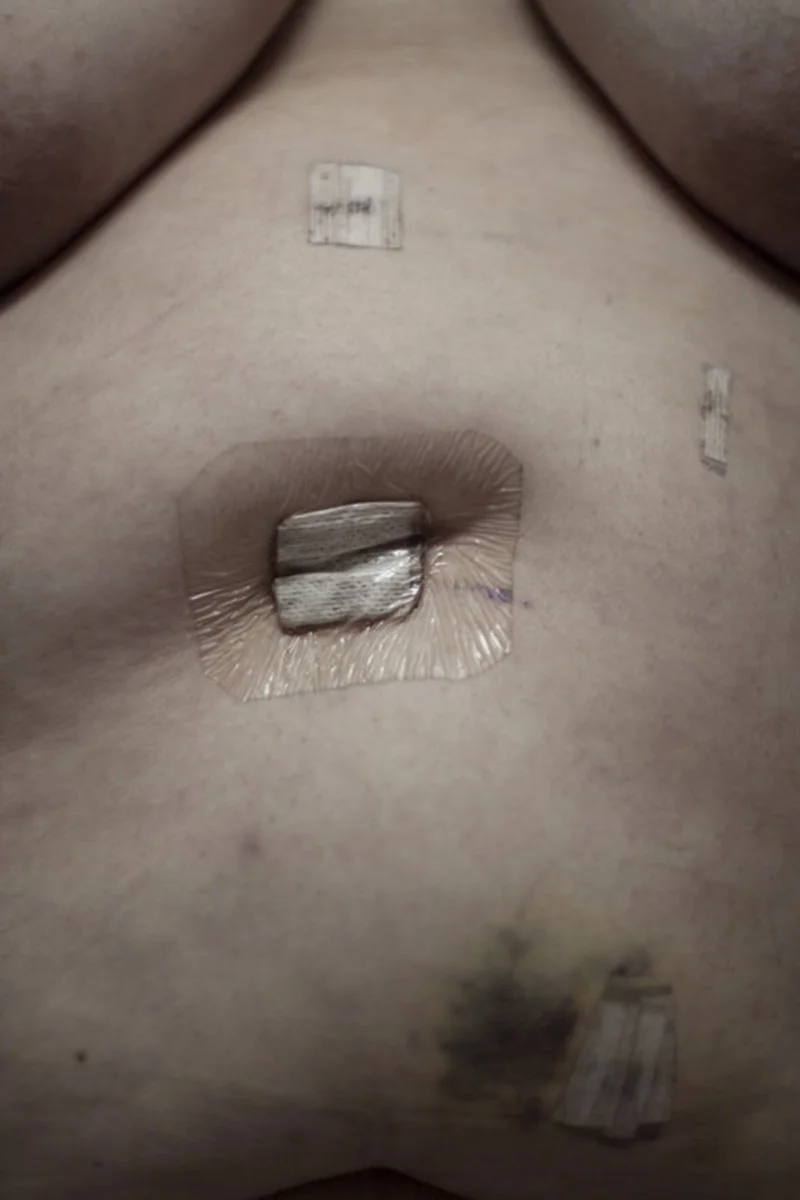 Close-up of surgical incisions and bruises as a result of sleeve gastrectomy.