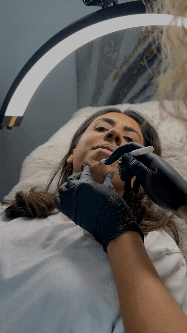 A woman lying on a medical bed receiving a cosmetic laser treatment on her chin from a professional wearing black gloves, with a bright ring light overhead.