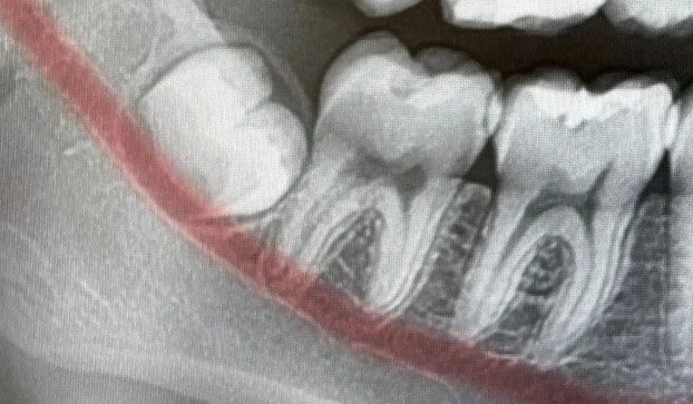 Impacted Wisdom Teeth