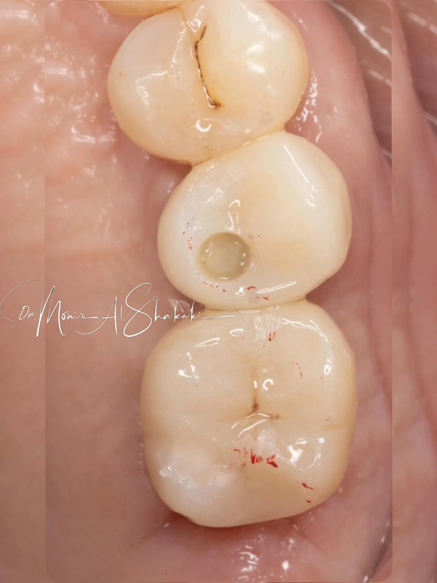 Dental implants placed to restore function and aesthetics 🌱🌱
قمنا ب زراعة زرعتين وأستعادنا الوظيفة الجمالية والمضغية 👌🏽
#dentalimplant #implantdentistry #oralsurgery